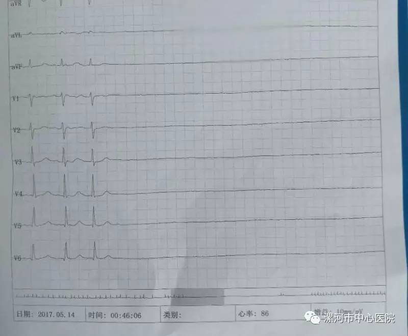 起搏器植入术前病人有心跳骤停发作的心电图 可见病人在十多秒内无