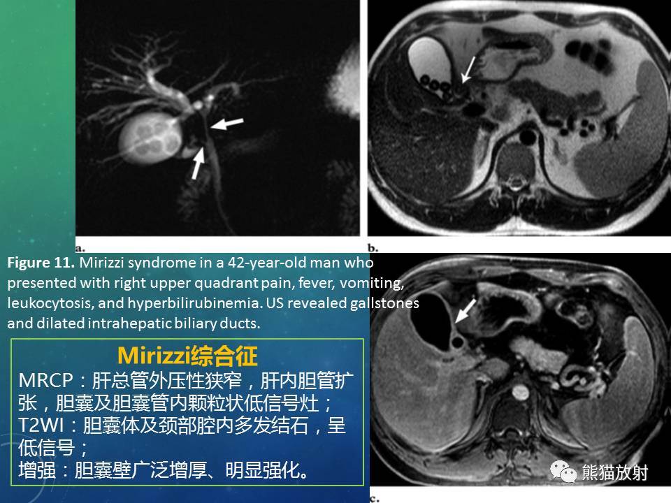 【专题】正常胆囊及胆囊病变的mri表现