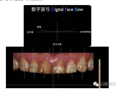 3,确定前牙龈缘高度,长宽比例,大小比例绘制牙齿形态曲线完成美学设计