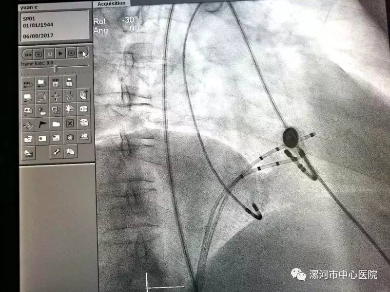 消频手术正在进行 消融导管需要在心脏内进行微创消融