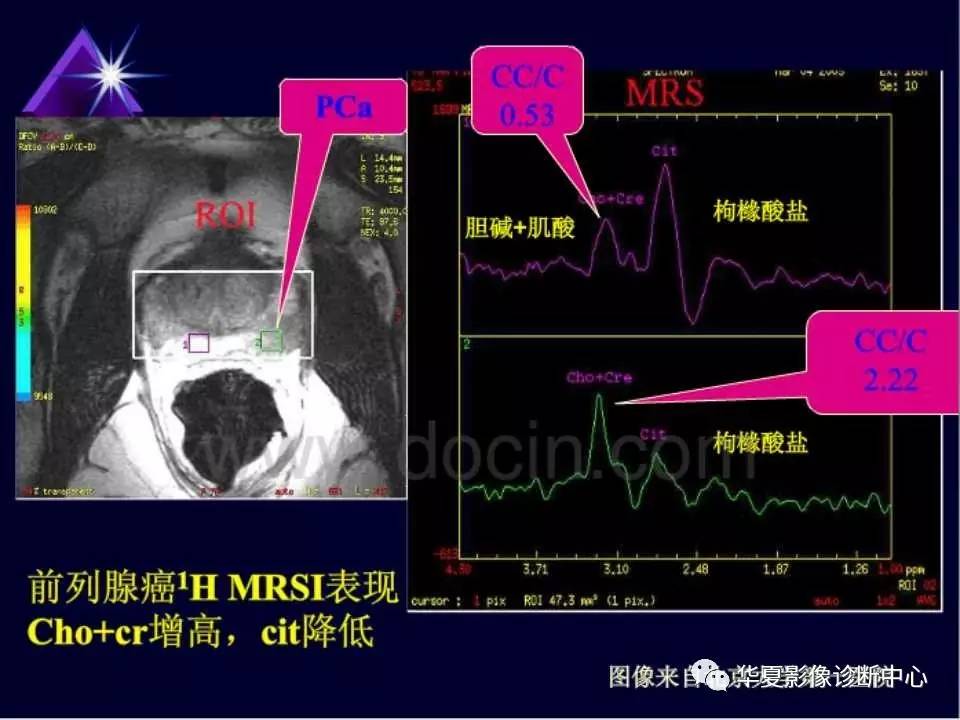 磁共振波谱分析(mrs)的应用