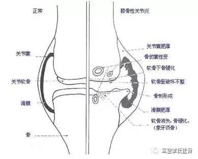 风湿手肿怎么办