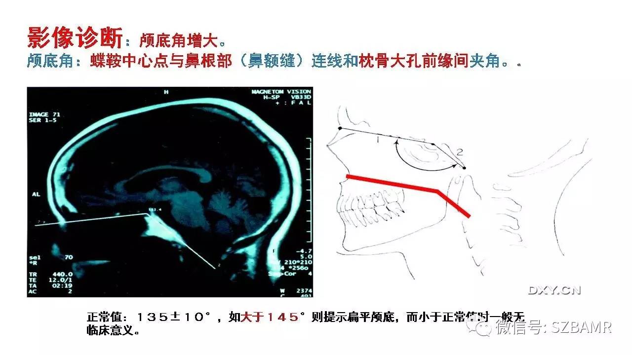 颅底交界区畸形影像诊断