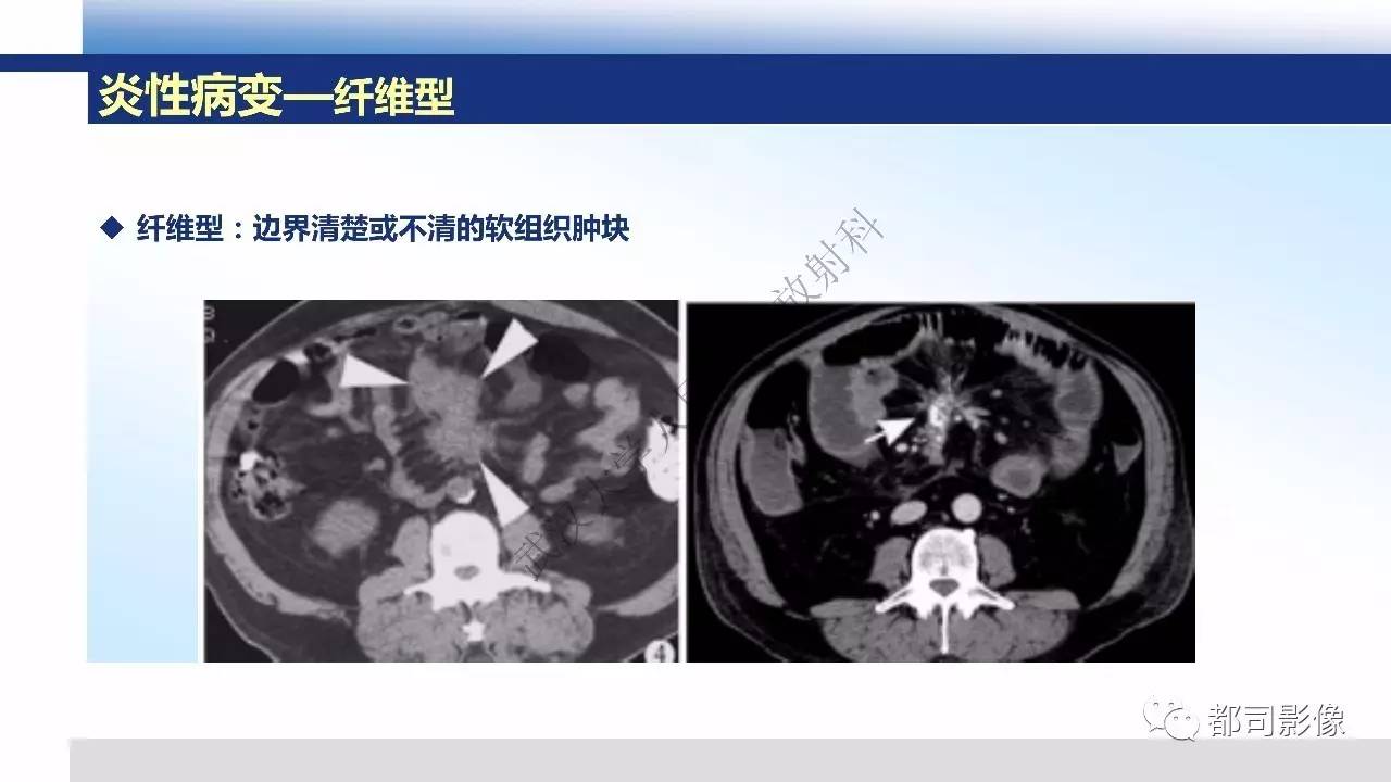 腹膜解剖及炎性病变影像诊断