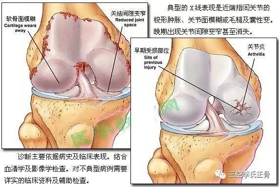 风湿手肿怎么办