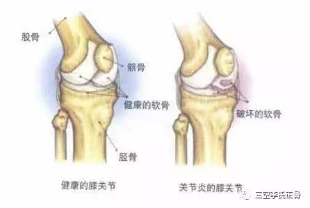 风湿手肿怎么办