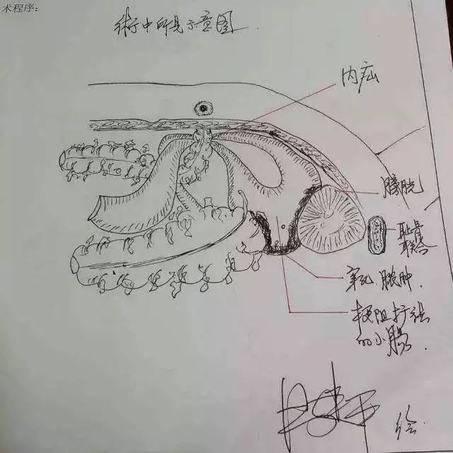 这是对一位复发患者的结肠癌团块进行切除的手术图谱