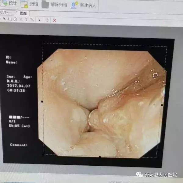 晚期食管癌胃镜下食管支架植入术