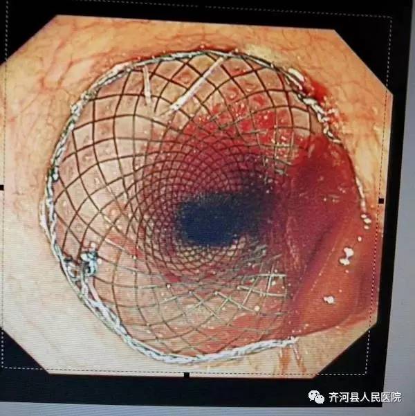 晚期食管癌胃镜下食管支架植入术