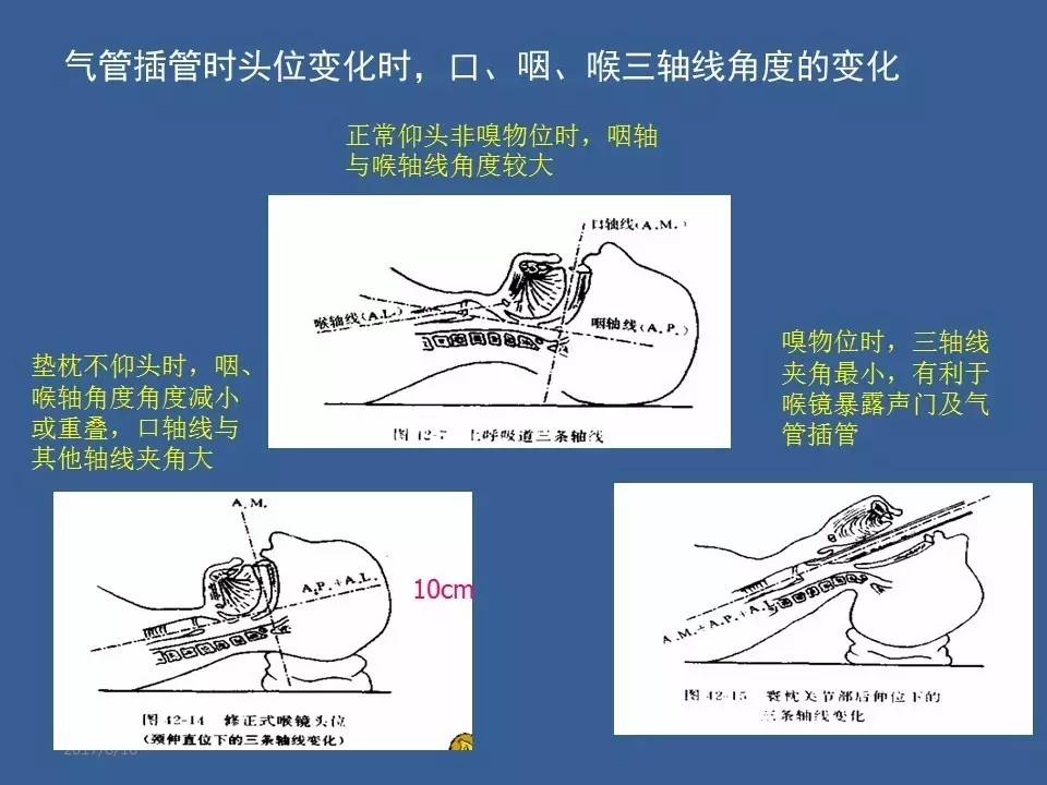 原创 基于杠杆原理的不同喉镜气管插管二维模型的创建与简易力学分析