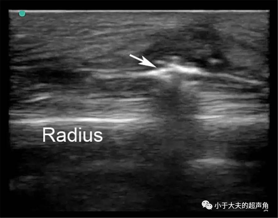 【超声】坏死性筋膜炎 necrotizing fasciitis【文献