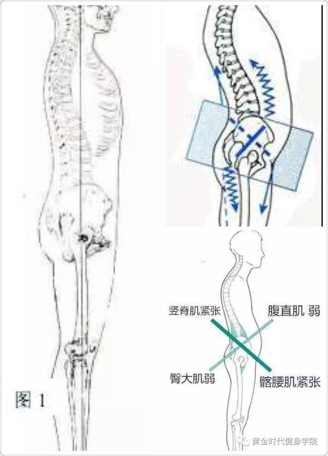 【专业资讯】下交叉综合症解决方案