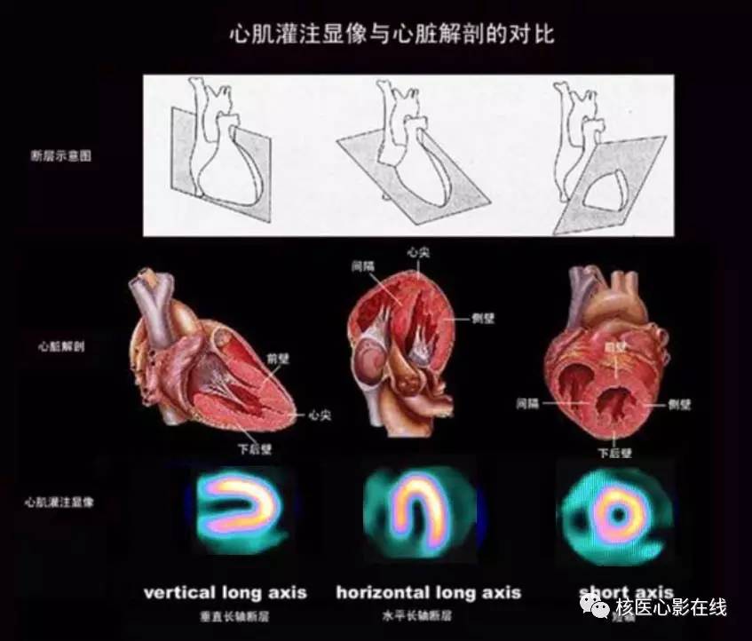 正常情况下,spect心肌灌注显像只显示左心室各壁(前壁,心尖,侧壁,下壁