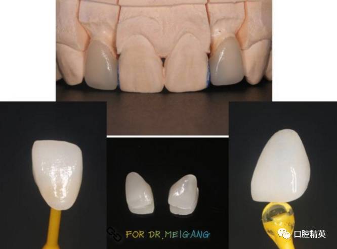max瓷贴面修复 (1)去龋净,树脂充填 (2)贴面预备 (3)取模型,比色 (4)