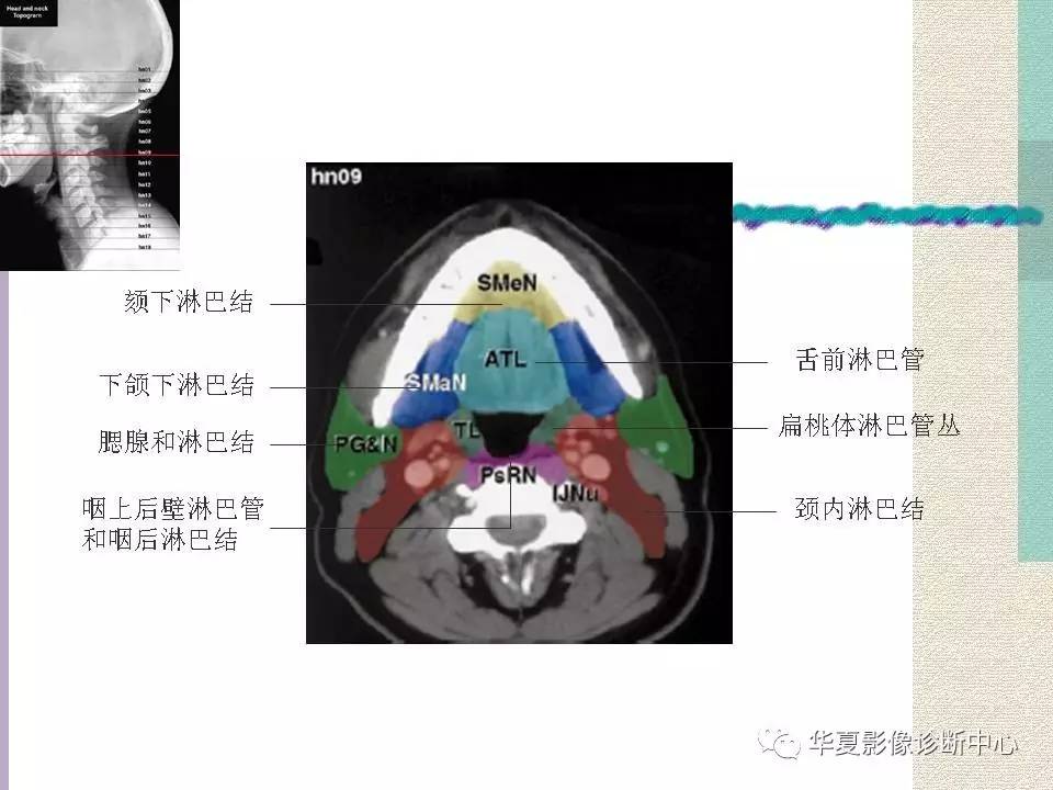 【影像基础】头颈部淋巴结断层分区图谱