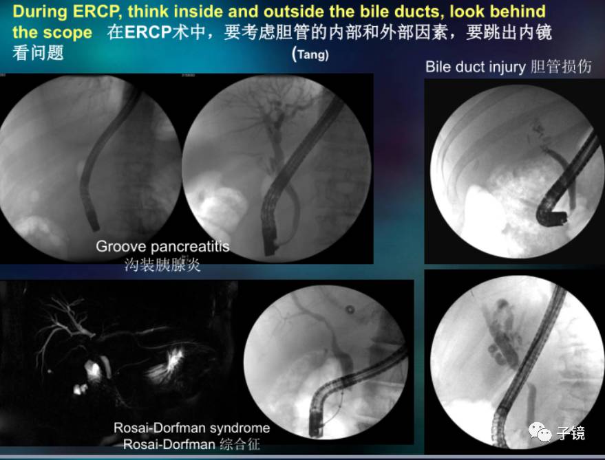 河医大学二院2017年第2期ercp培训系列之理论培训学习笔记