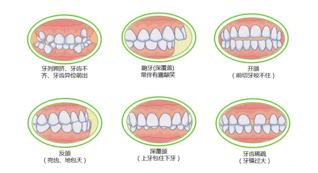 咬合诱导技术能够矫正哪些类型的牙齿?