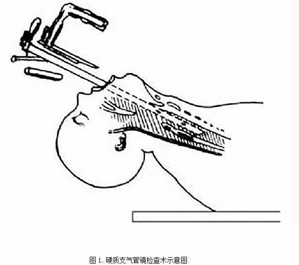 临床技能硬质气管镜下介入治疗的麻醉管理