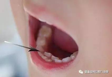 影响健康又毁容的"双排牙"你家宝宝有吗?