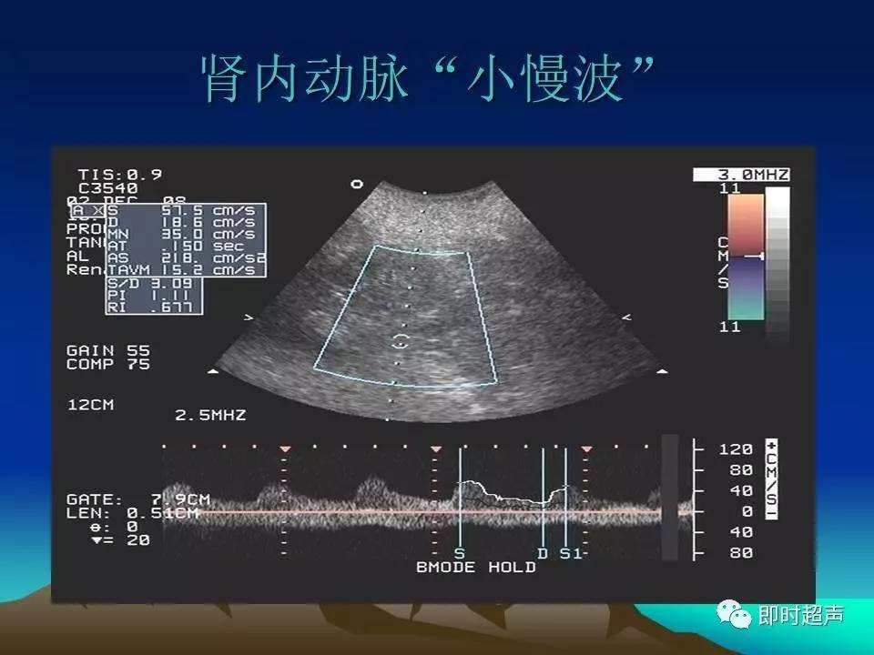 肾动脉狭窄超声诊断研究