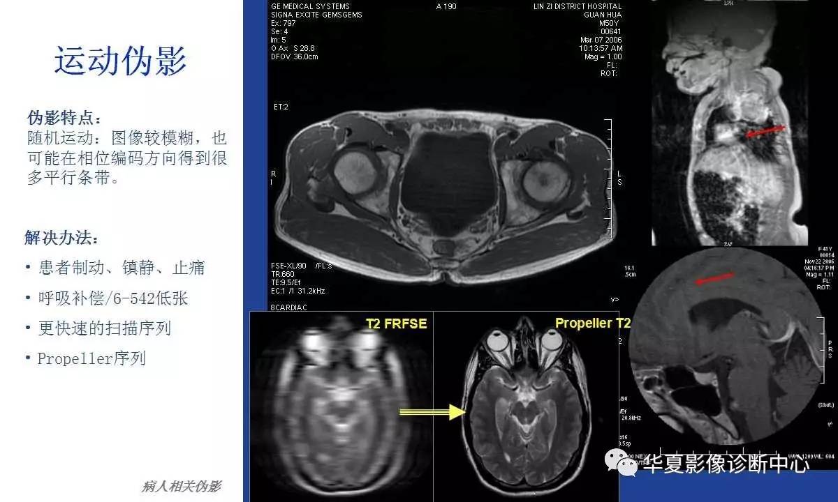 关于磁共振伪影