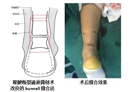 新技术|我院成功完成全市首例"跟腱断裂通道微创术"