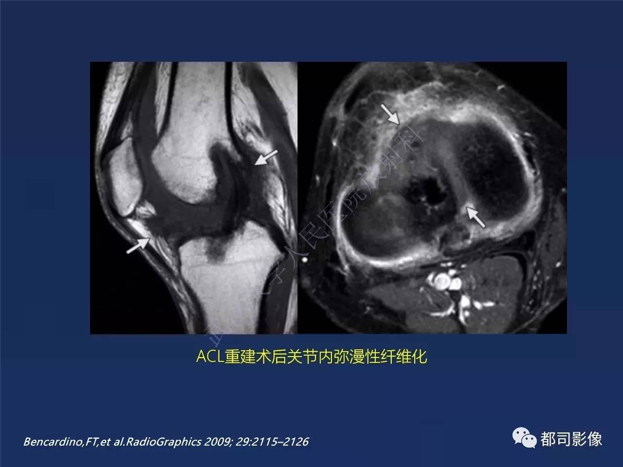 前交叉韧带损伤及重建术后mr评价