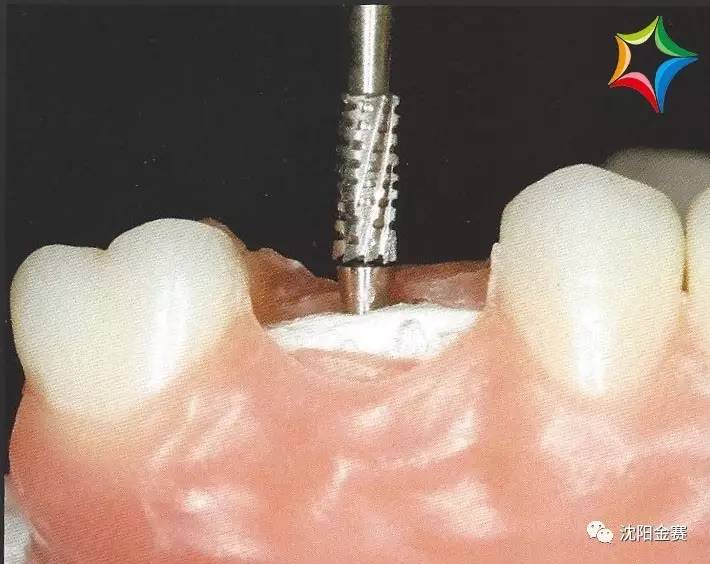 【金赛义齿】固定螺丝固位种植体病例2