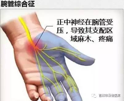 治疗本病的关键在于增大腕管容积,消除腕横韧带对正中神经的压迫和腕