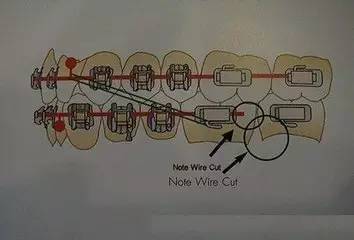 正畸过程中橡皮筋的作用