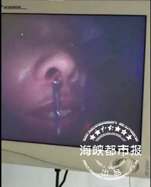 【吓人】男子鼻腔内"养"了只吸血蚂蟥,竟和洗脸有关!