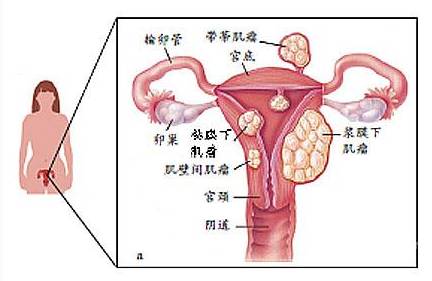 也是人体中最常见的肿瘤之一,又称为纤维肌瘤,子宫纤维瘤