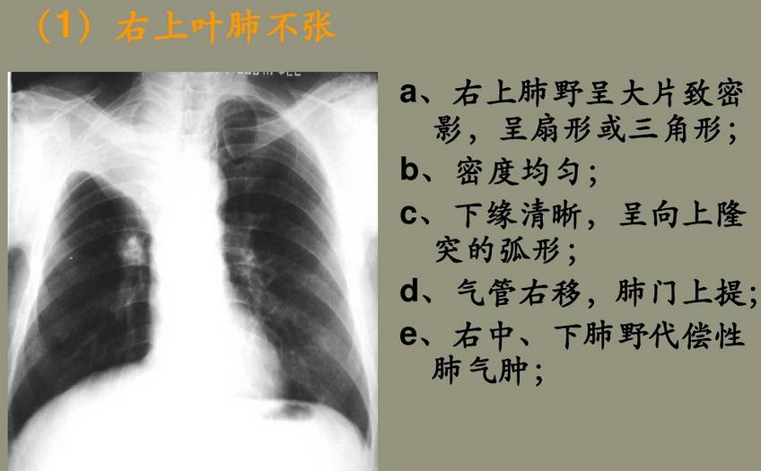【x线诊断要点】关于"肺不张",需要弄清楚以下几点