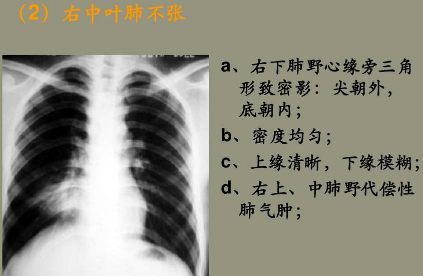 x线诊断要点关于肺不张需要弄清楚以下几点