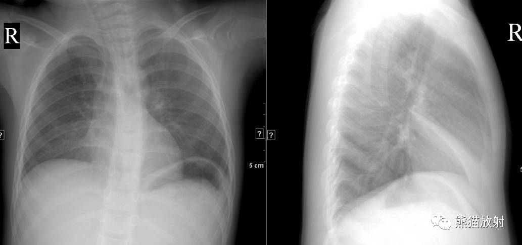 盘状肺不张也呈线样肺不张,是亚肺段性不张的一种特殊x线表现形态.