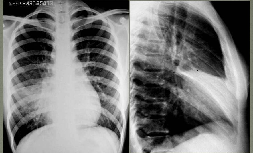 盘状肺不张也呈线样肺不张,是亚肺段性不张的一种特殊x线表现形态.