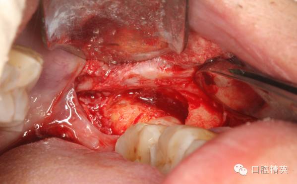 下颌倒置阻生智齿的拔除