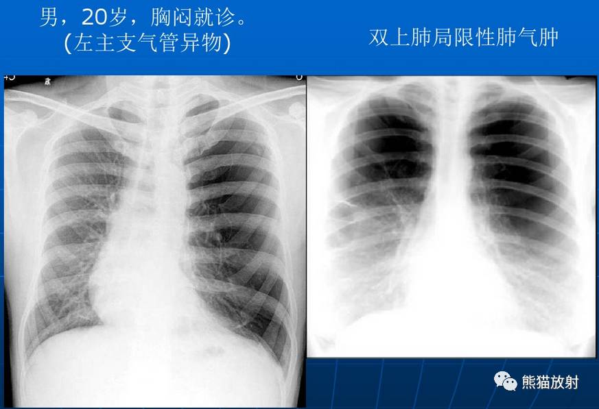 【x线诊断要点】关于"肺气肿"的一些概念,需要熟悉!