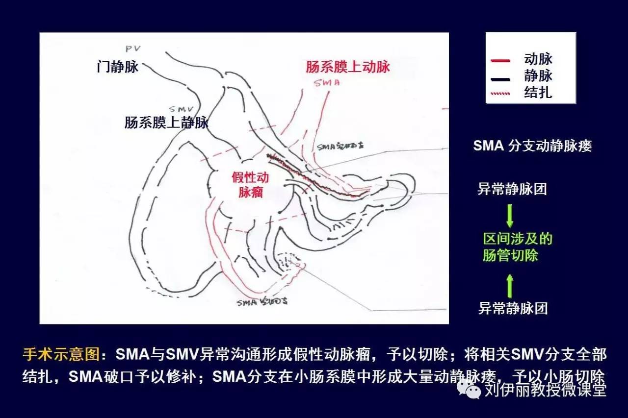 外伤性门静脉肺动脉高压症