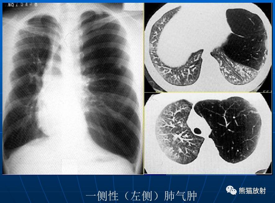 慢性阻塞性肺气肿的发病机制:↓ 间隔旁型肺气肿结合ct学习,以下内容