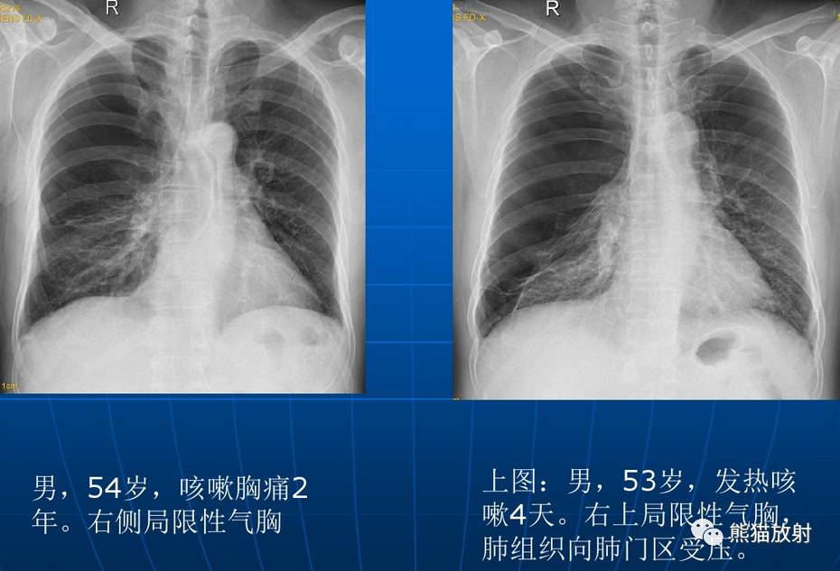 【x线诊断要点】关于"肺气肿"的一些概念,需要熟悉!
