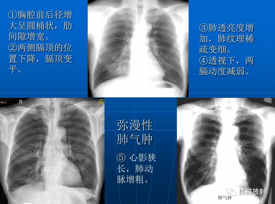 【x线诊断要点】关于"肺气肿"的一些概念,需要熟悉!(结合ct)