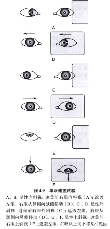 专业遮盖诫验单眼遮盖试验斜视弱视检查法十
