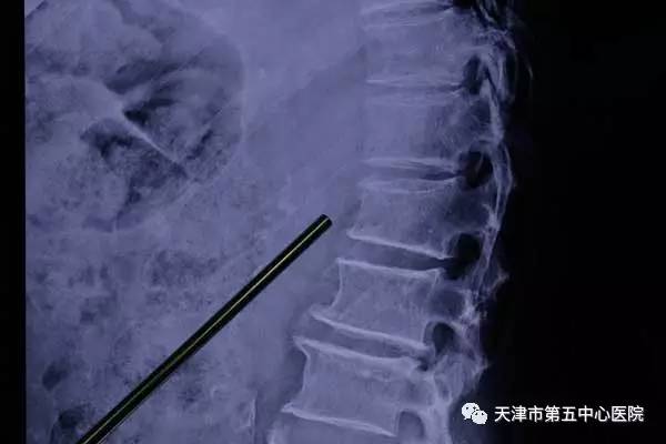 x光片提示椎体发生压缩性骨折