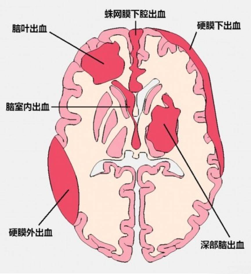 几种类型脑出血的ct表现