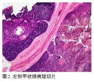 小儿甲状腺实质内异位胸腺1例