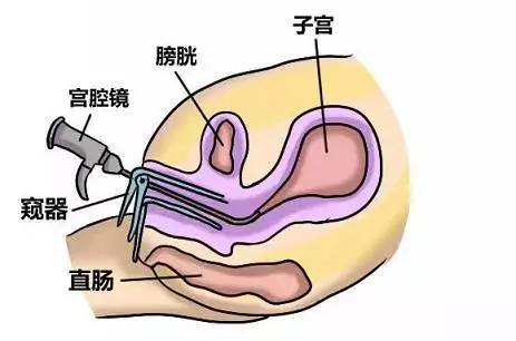 生育的困扰——宫腔粘连!