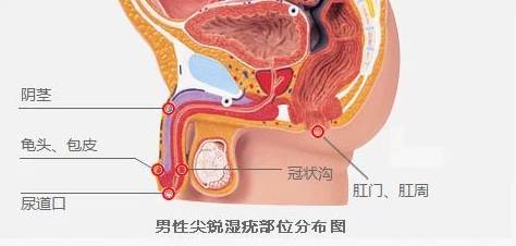 典型尖锐湿疣图片及三种方法判断是否感染尖锐湿疣