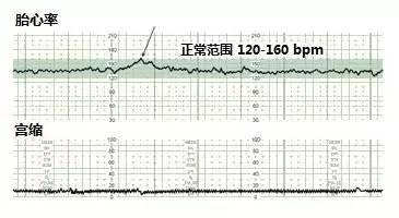 胎心的正常范围是多少?正常胎心率为120~160次/分.