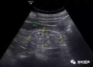 【影像病例】双肾弥漫性病变一例